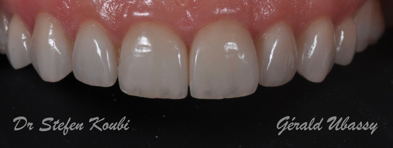 Veneers Dr Koubi/Ubassy